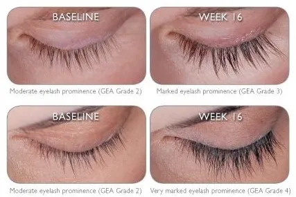 Latisse before and after