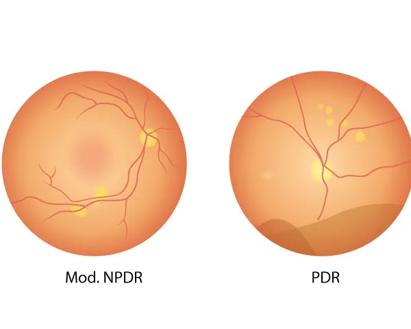 4 stages diabetic retinopathy