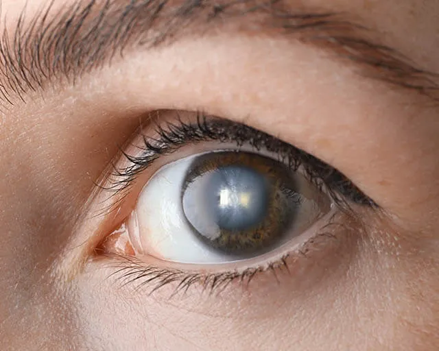 Close-up of human eye showing visible signs of cataract clouding