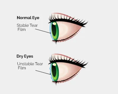 Diagram comparing normal eye tear film to dry eye condition