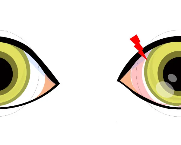 dry eye myopia