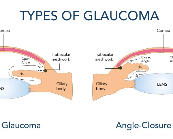glaucoma type
