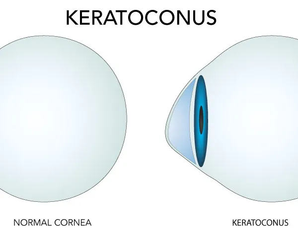 keratoconus