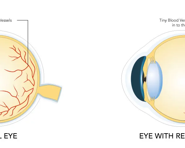 retinopathy
