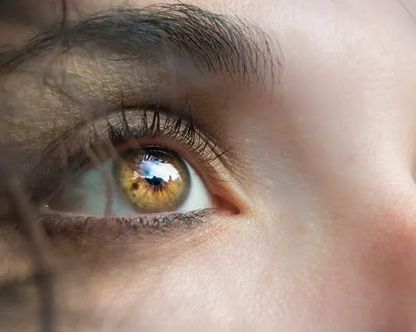 Woman with Meibomian Gland Dysfunction